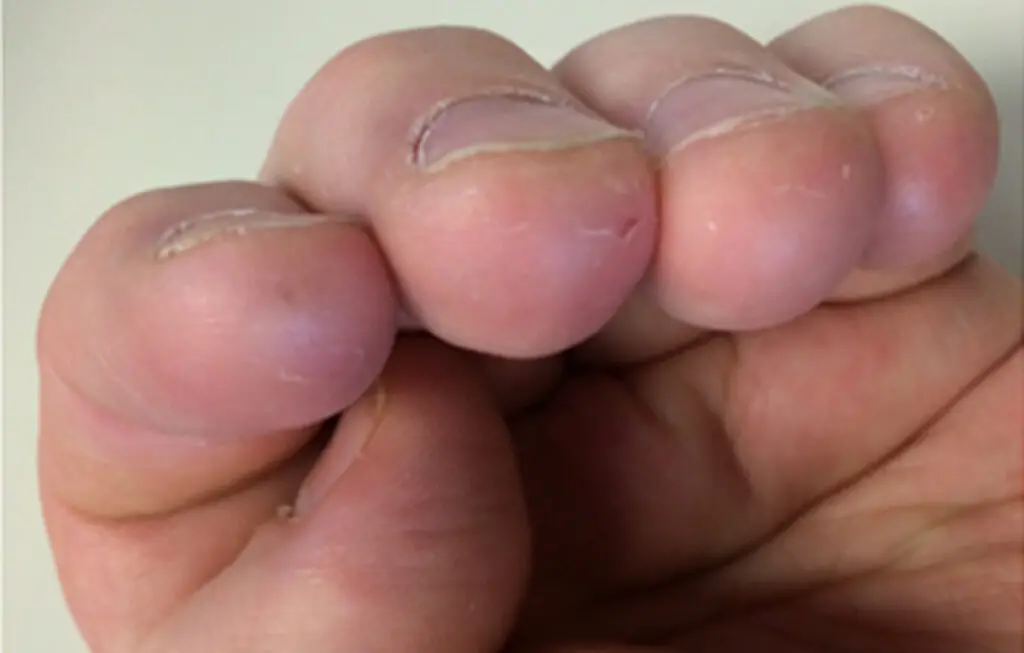 Fingertip Calluses